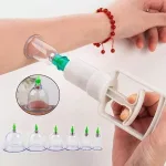 6 részes vákuumterápiás köpölyöző készlet – fájdalomcsillapításhoz, izomlazításhoz