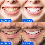 Magic Brite 5D fogfehérítő csíkok